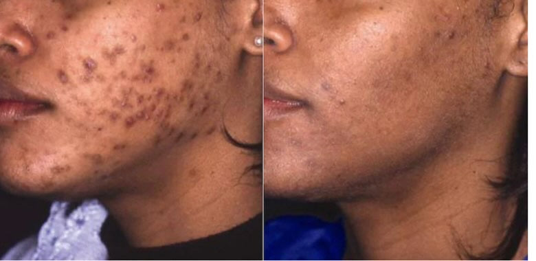 Beautiful skin in just 1 week